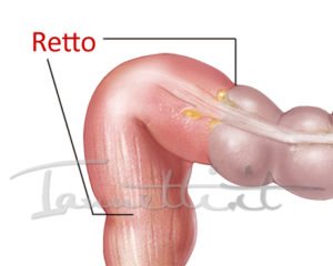 RETTO COLON RETT0
