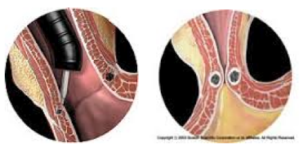 Iniezione sottomucosa di Enteryx e risultato della procedura