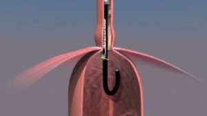Metodica Esophyx sotto visione endoscopica