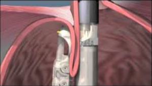 EndoLuminal GastroPlication (ELGP) con Esophyx