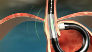 Sistema MUSE (Medigus Ultrasonic Surgical Endostapler)