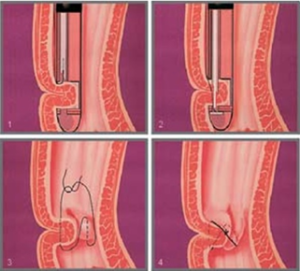 Procedura Endocinch