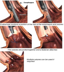 Metodica di Fundoplicatio Endoscopica con Endocinch: con suture multiple si ottiene una neo-valva (da Webmedicine)