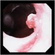 Tumore esofago: polipo imperplastico Polipi esofago iperplastico