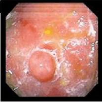 polipo gastrico tumorale (adenoma) Polipo adenomatoso