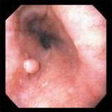 Tumore esofago: papilloma squamoso Tumore esofago: papilloma squamoso