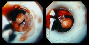 Visione di una varice appena legata: si vede il laccio che la stringe alla base alt="Visione di una varice appena legata: si vede il laccio che la stringe alla base"