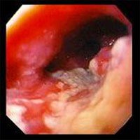 Adenocarcinoma dell'esofago Adenocarcinoma dell'esofago